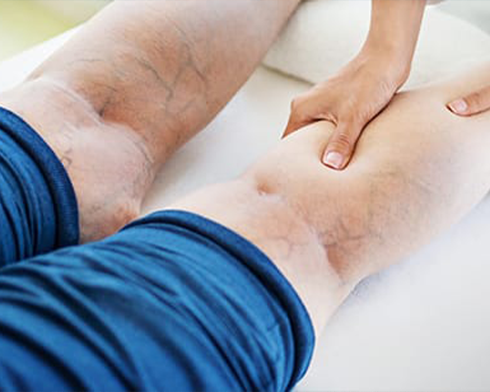 Understanding Venous Insufficiency: Causes, Symptoms, and Management -  Longmore Clinic