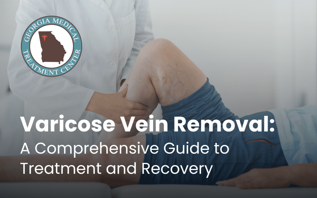 Varicose Vein Removal: A Comprehensive Guide to Treatment and Recovery