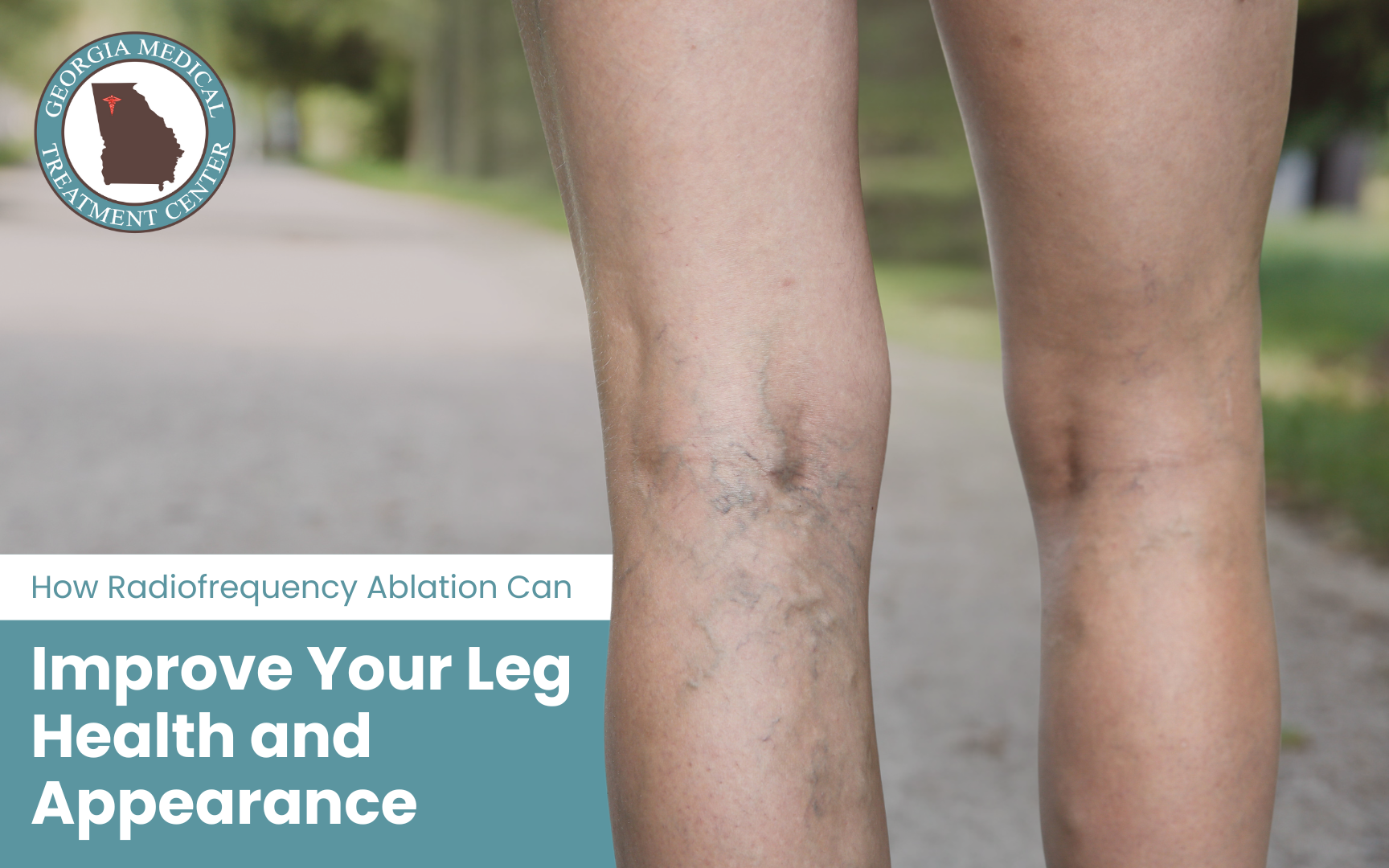 How Radiofrequency Ablation Can Improve Your Leg Health and Appearance