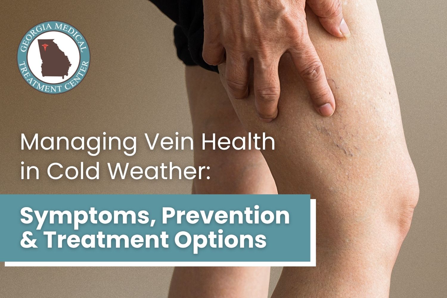 Close-up of a person's leg showing visible varicose veins, illustrating vein health symptoms in cold weather